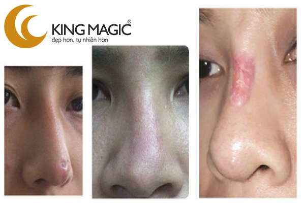 PT chỉnh lại mũi làm không đạt