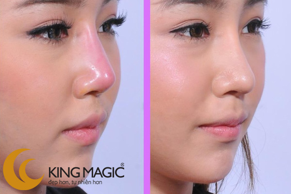 PT chỉnh lại mũi làm không đạt