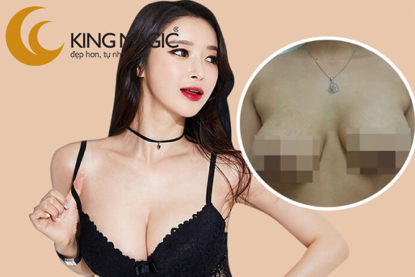 Chỉnh lại túi ngực đặt lần trước