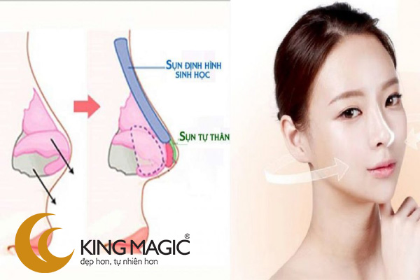 Nâng mũi bọc sụn