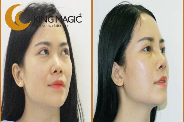 Nâng mũi bọc sụn