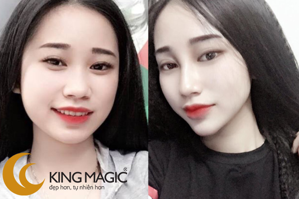 Nâng mũi cấu trúc