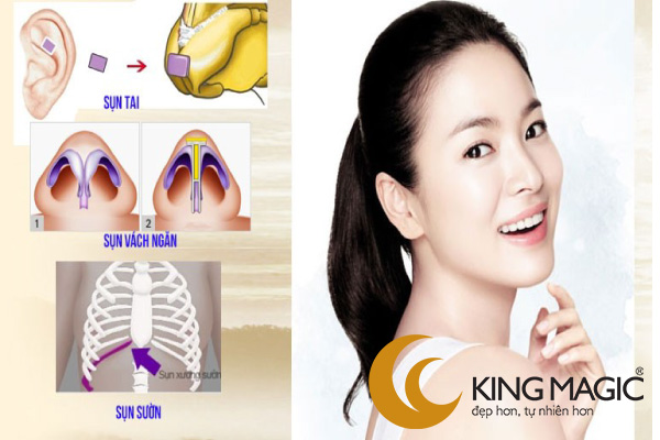 Nâng mũi cấu trúc