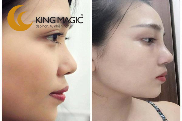 Nâng mũi kiểu Hàn Quốc
