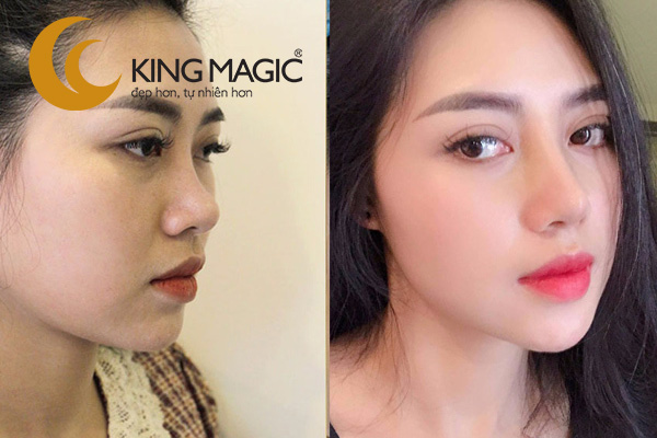 Nâng mũi sụn nhân tạo