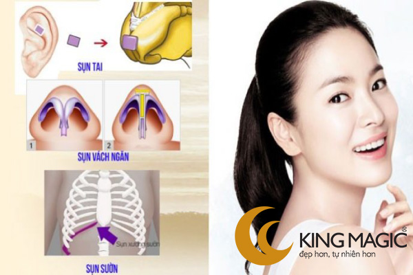 Nâng mũi sụn tự thân