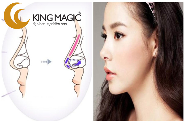 Nâng mũi sụn tự thân