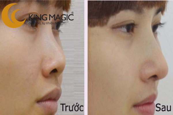 Nâng mũi sụn tự thân