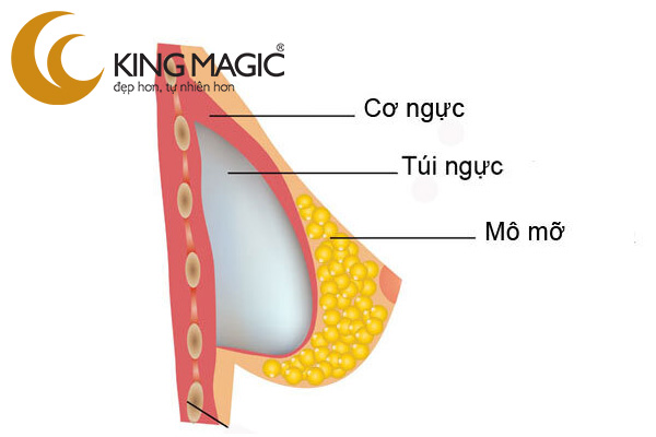 Nâng ngực dưới cơ qua đường quầng vú