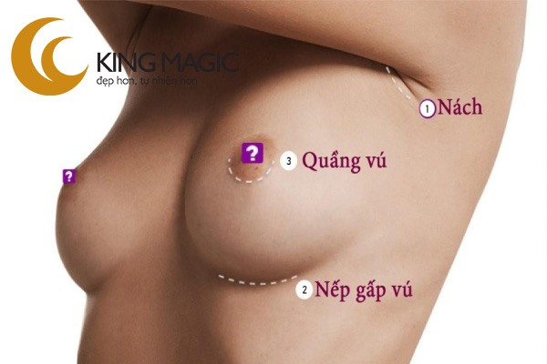 Nâng ngực dưới cơ qua đường quầng vú