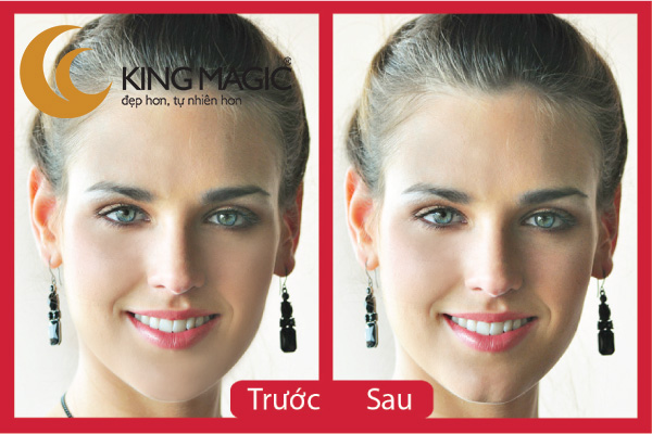 Phẫu thuật cằm chẻ