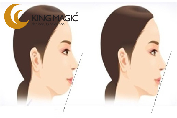 Phẫu thuật cằm lẹm