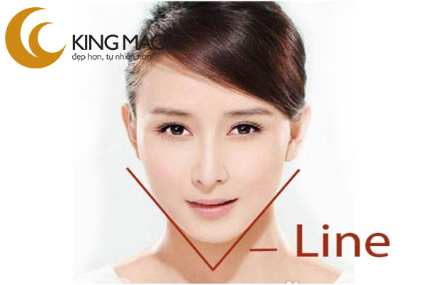 Phẫu thuật cằm Vline