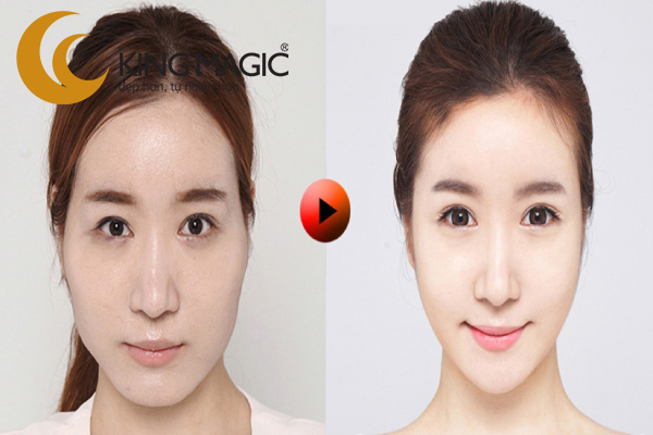 Phẫu thuật cằm Vline