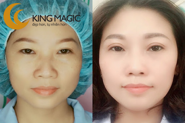 Phẫu thuật cắt mắt hai mí