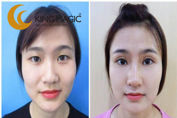 Phẫu thuật cắt mắt hai mí