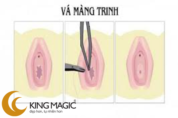 phẫu thuật khâu màng trinh