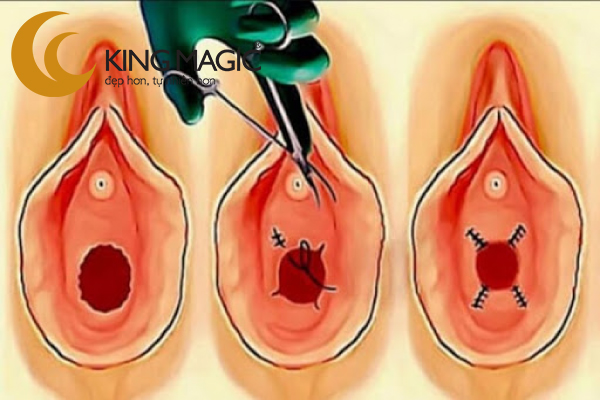tái tạo lớp màng trinh đã bị rách ở chị em