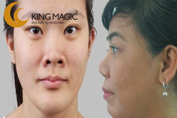 Phẫu thuật làm dài mũi