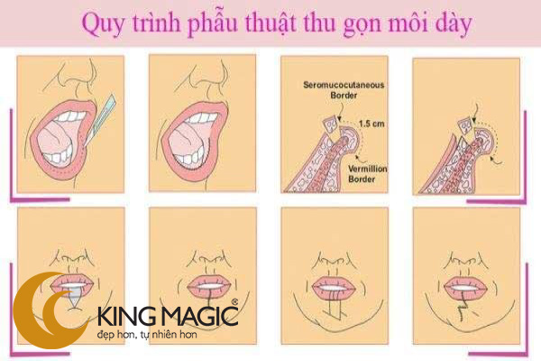 Phẫu thuật làm mỏng môi
