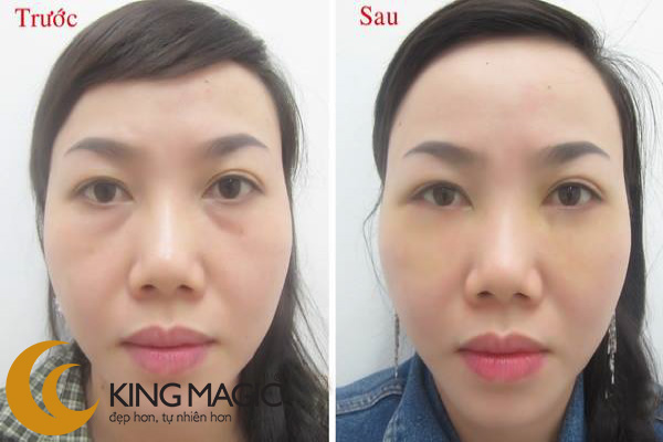 Phẫu thuật lấy da/mỡ mí dưới