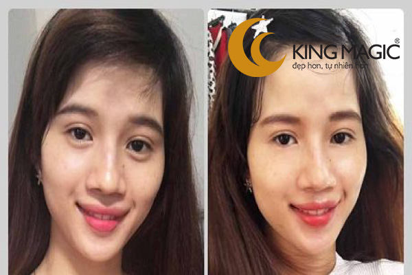 Phẫu thuật lấy da/mỡ mí dưới