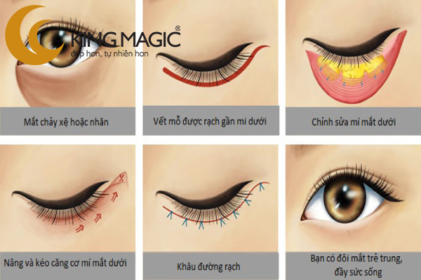 Phẫu thuật lấy da/mỡ mí dưới