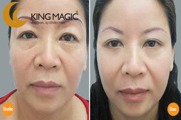 Phẫu thuật lấy da/mỡ mí trên