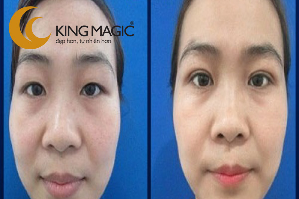Phẫu thuật lấy da/mỡ mí trên không cắt mí