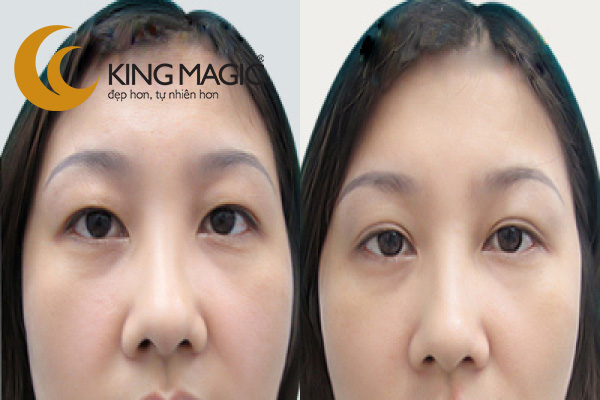 Phẫu thuật lấy da/mỡ mí trên không cắt mí
