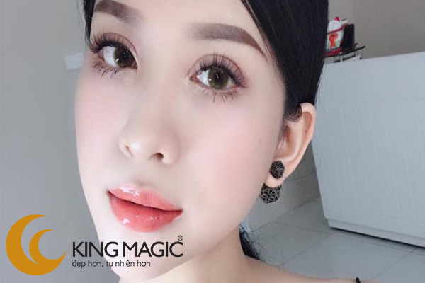Phẫu thuật mở rộng khe mắt