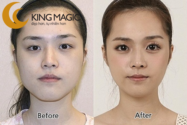 Phẫu thuật mở rộng khe mắt