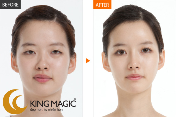 Phẫu thuật mở rộng khe mắt