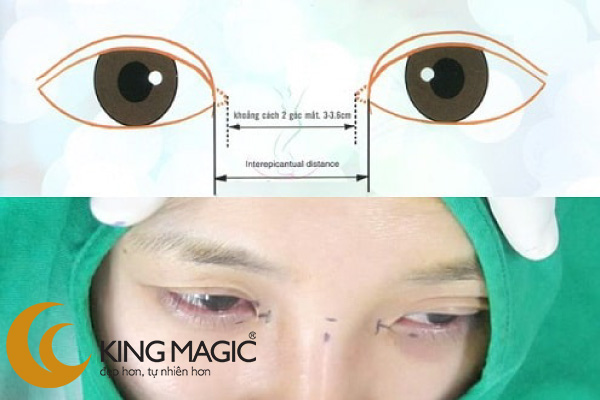 Phẫu thuật mở rộng khe mắt