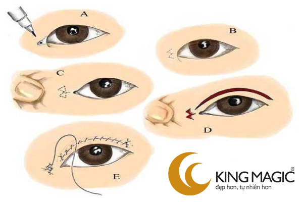 Phẫu thuật mở rộng khe mắt