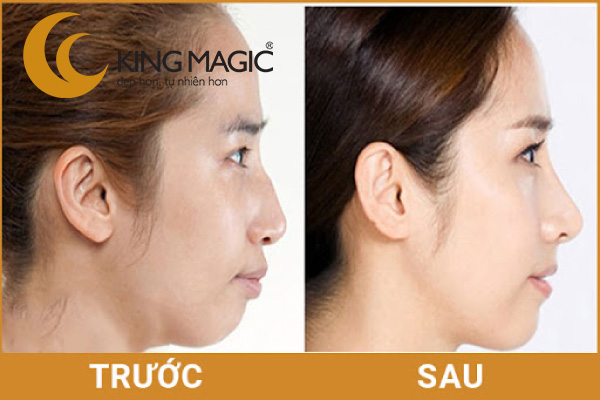 Phẫu thuật mũi gồ