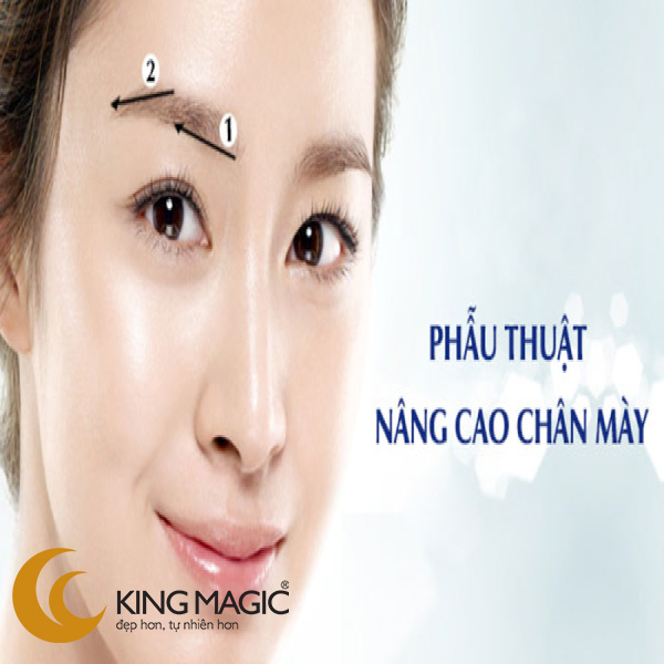 Phẫu thuật nâng chân mày