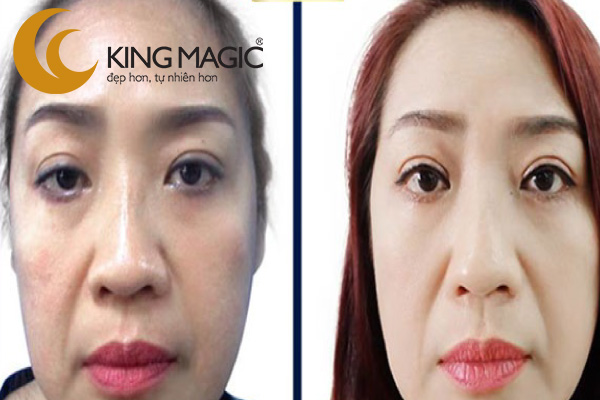 Phẫu thuật nâng chân mày