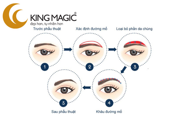 Phẫu thuật nâng chân mày
