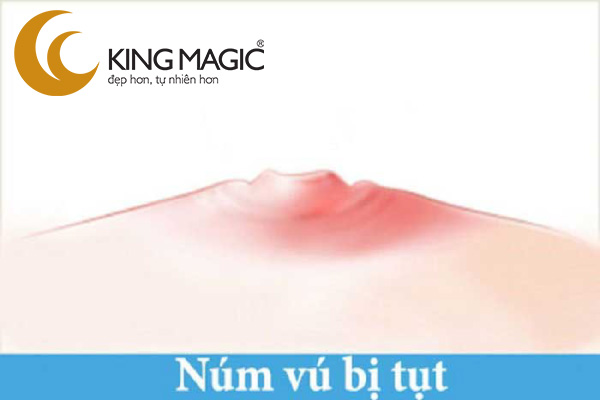 Phẫu thuật nâng đầu vú tụt