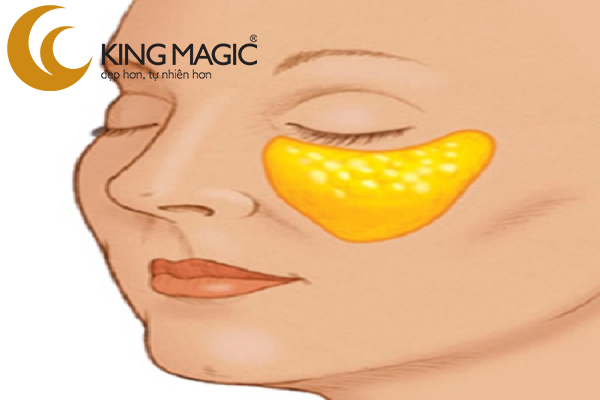 phẫu thuật nâng gò má