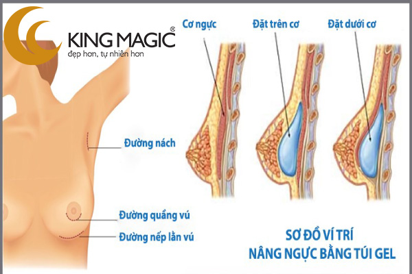 Phẫu thuật nâng ngực trên cơ