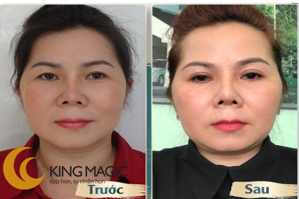 Phẫu thuật nội soi nâng chân mày