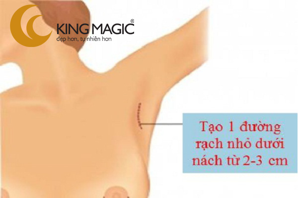 Phẫu thuật nội soi nâng ngực