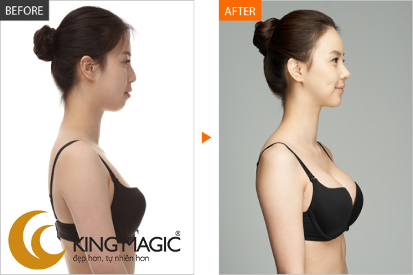 Phẫu thuật nội soi nâng ngực