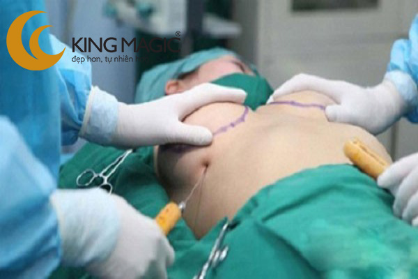 Chỉnh lại túi ngực đặt lần trước
