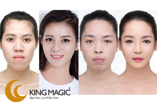Phẫu thuật tạo hình đầu mũi