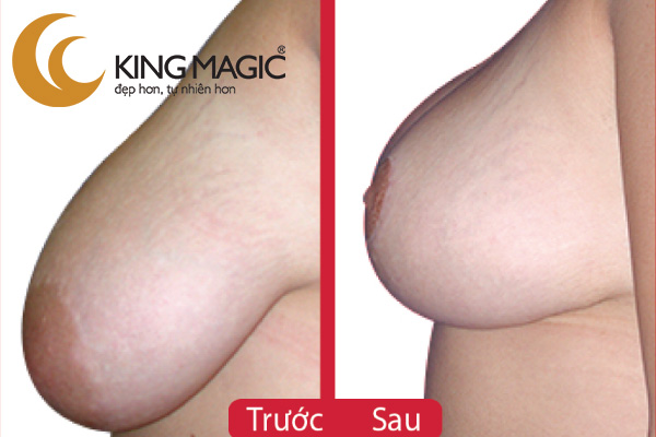 Phẫu thuật thu nhỏ ngực