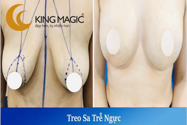 Phẫu thuật treo ngực