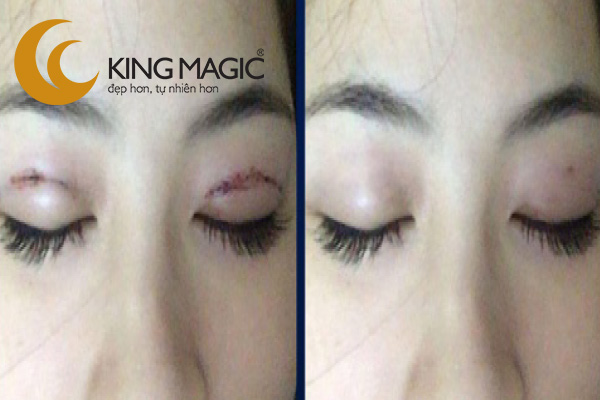 Phẫu thuật xử lý sẹo vùng mắt